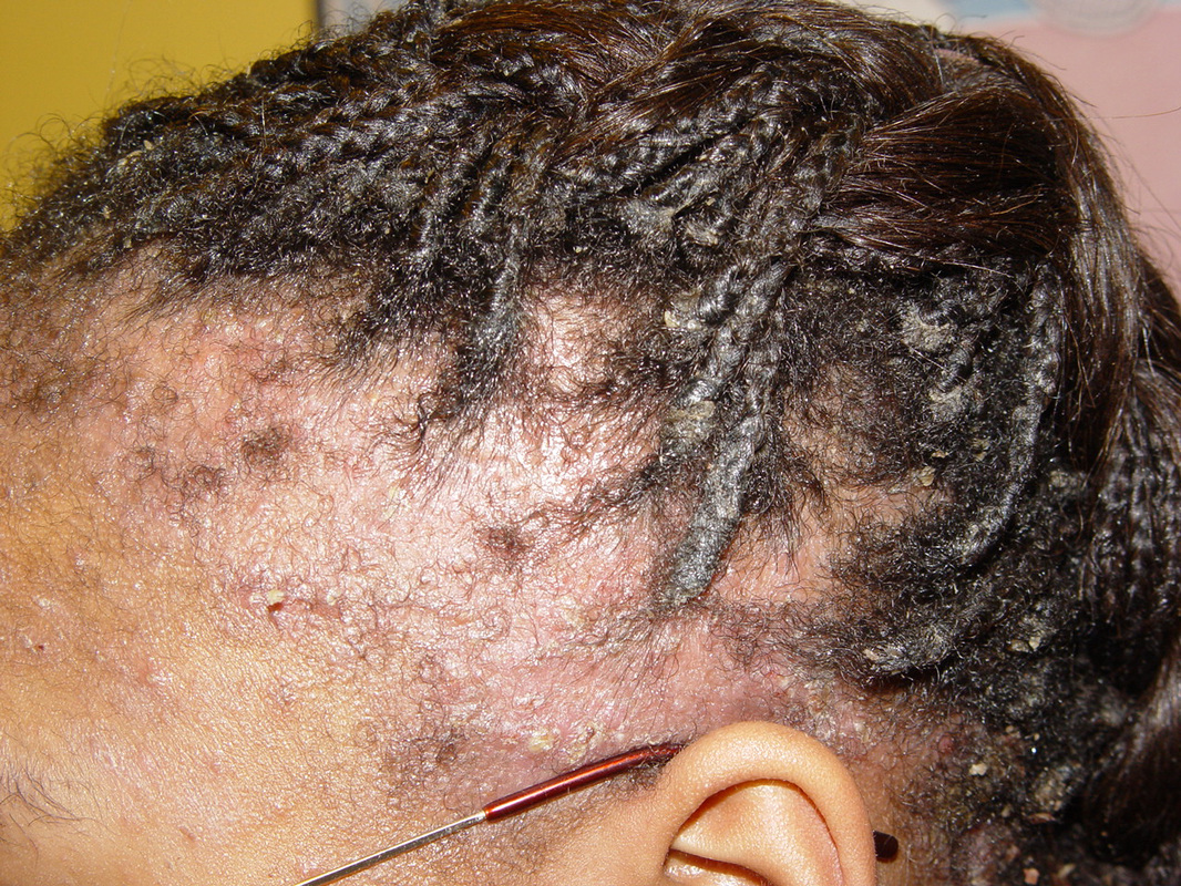 seborrheic dermatitis scalp african american hair